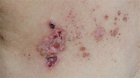 Pictures Of Shingles Rash On Lower Back Picturemeta