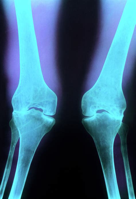 X Ray Of Knee Joints With Rheumatoid Arthritis Photograph By Princess