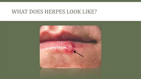 What Does Herpes Look Like And How Do I Know If I Have It Youtube