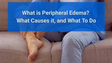 Peripheral Edema Causes Symptoms And Treatments Youtube