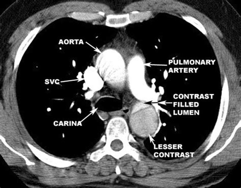 Aortic Dissection