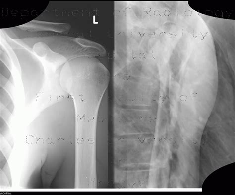 Radiology Case Acromioclavicular Joint Separation
