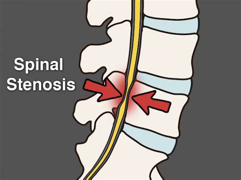 Spinal Stenosis Surgery Risks Cost Recovery Treatment Sutured