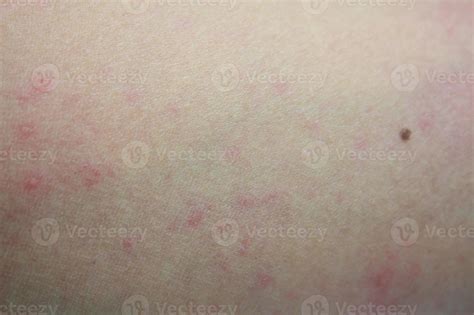 Malade éruption Cutanée Allergique Dermatite Eczéma Peau Du Patient