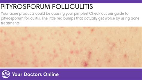 Pityrosporum Folliculitis Causes Symptoms Treatments And Prevention