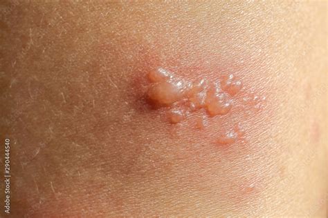 Skin Rash As Allergic Symptoms Due To Arm Fiberglass Cast Stock Photo