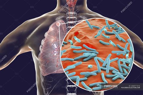 Infección Pulmonar Secundaria Por Tuberculosis Y Primer Plano De La