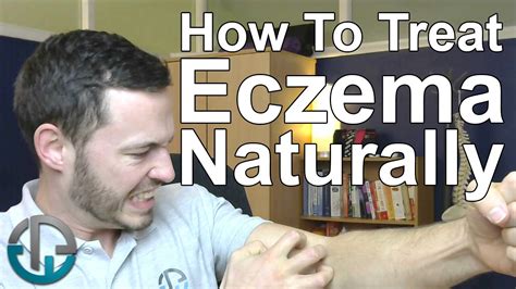 How To Treat Eczema Naturally Youtube