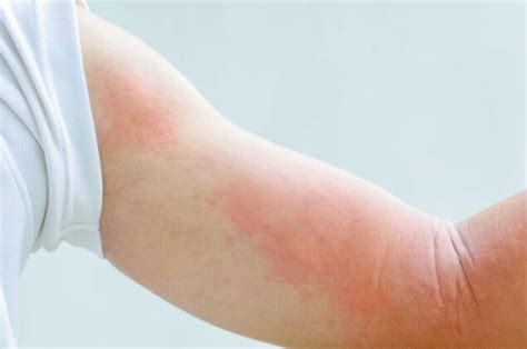 1 Exercise Induced Urticaria Symptoms And Causes