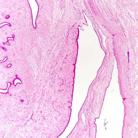 Pathology Outlines Phyllodes Tumor