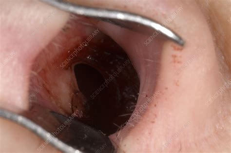 Perforated Nasal Septum Stock Image M Science Photo Library