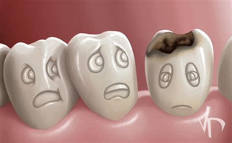 Etiology Of Dental Caries Vdm Dental Blog Ny 10014