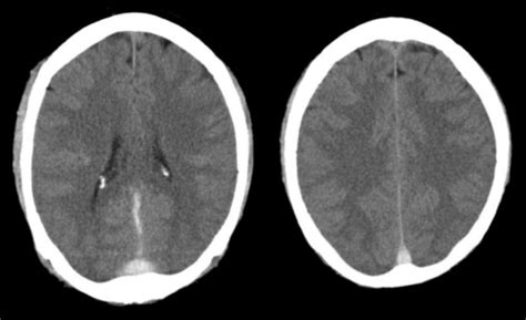 Sagittal Sinus Ct