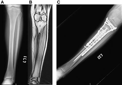 A 23 Year Old Woman Case 10 With Ewing Sarcoma Of The Left Tibia