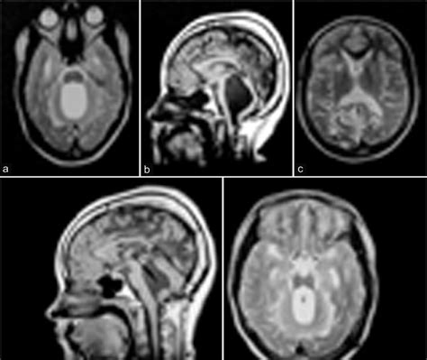 Preoperative Magnetic Resonance Imaging Mri View Of The Trapped