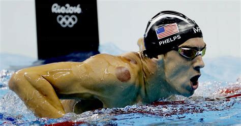What Is Cupping And Why Is It Leaving Some Olympians With Spots