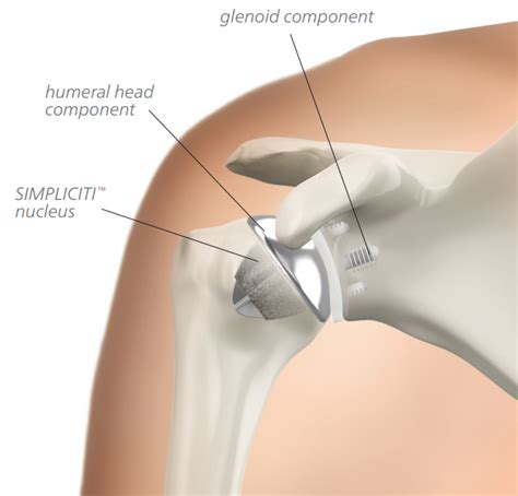 We will attempt to provide a simplified overview of this complex anatomy. McKinley Orthopedic | Shoulder Pain