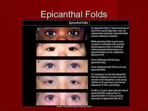 Epicanthal Folds