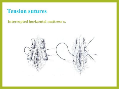 Basic Suture Patterns