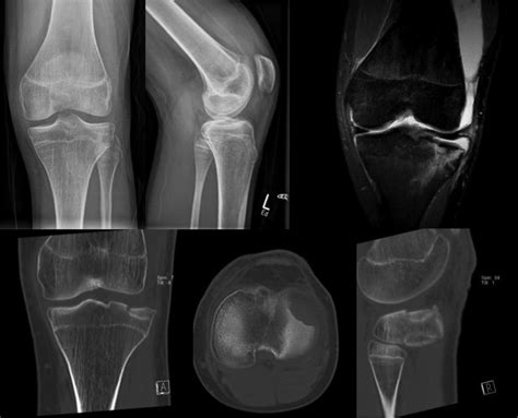 Minimally Invasive Treatment Of Tibial Plateau Depression Fractures