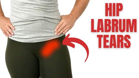 Hip Labral Tear What It Is How To Know If You Have It And What To Do