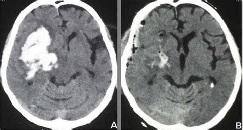 This is usually in form of while color matter in the brain. A: 58 year-old hypertensive gentleman with right basal ...