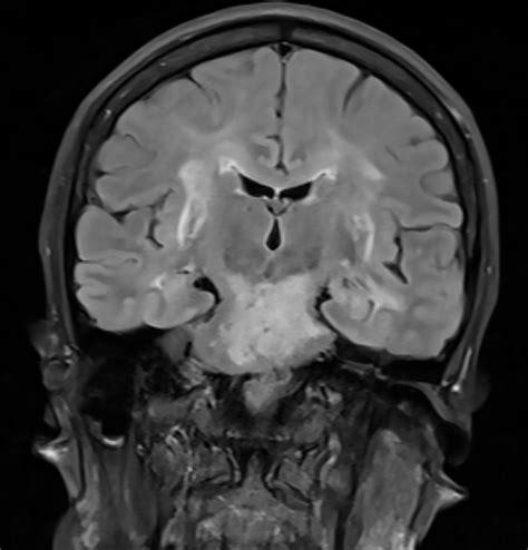 Hypertensive Encephalopathy Mimicking Cerebral Vasculitis With Pontine