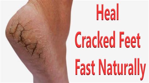 Heal Cracked Feet Fast Naturally With 8 Remedies How To Get Rid Of Dry And Cracked Feet Youtube