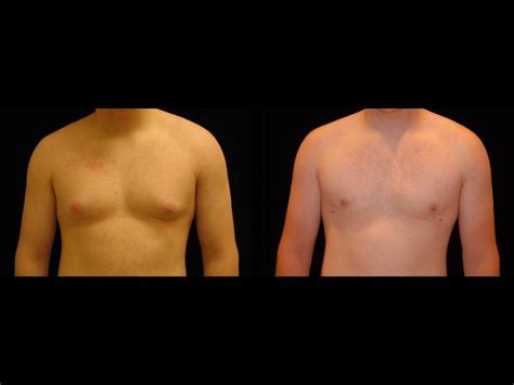 Gynecomastia Before And After Premier Plastic Surgery