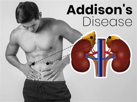 Addisons Disease Symptoms Causes Risk Factors And Treatment