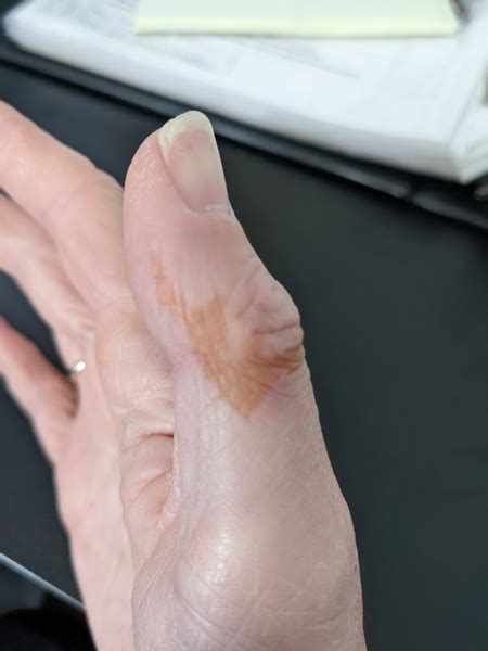 What Are These Orange Stains That Have Appeared On My Hands Overnight