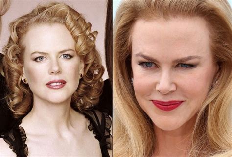 Nicole Kidman Et La Chirurgie Esthétique - Nicole Kidman plastic surgery (26) – Celebrity plastic surgery online
