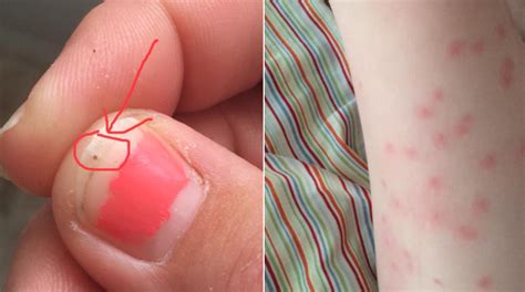 Mom Shares Terrifying Photos Of 3 Year Old Covered In Seed Ticks