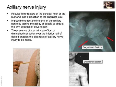 Applied Anatomy Axillary Nerve Injury