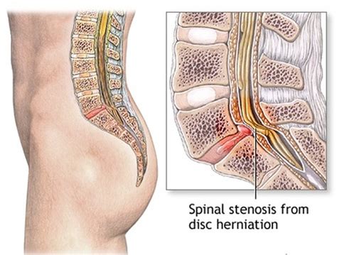 Symptoms And Treatments Of Spinal Stenosis Spinal Stenosis Surgery