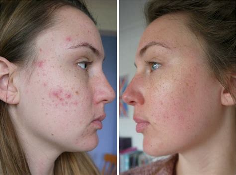 After Struggling With Acne My Dermatologist Prescribed Me Accutane