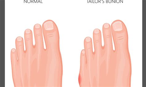 What Could Be Causing My Pinky Toe Pain Gait Happens