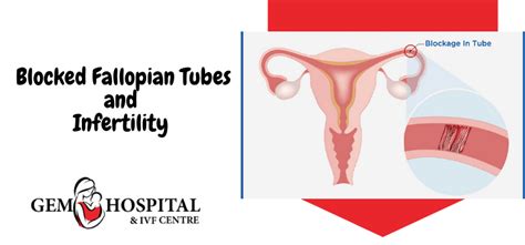 Causes Of The Blocked Fallopian Tubes How Can Ivf Help This Problem