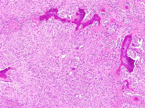 Pathology Outlines Nonossifying Fibroma