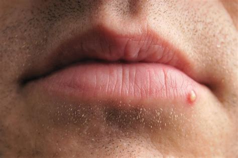 Painful blisters that break out around and inside your mouth and throat, later forming ulcers; Cold sore vs. pimple: Differences, similarities, and treatment