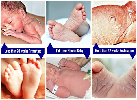 The Neonates With Images Gestational Age Kids Health Newborn Baby