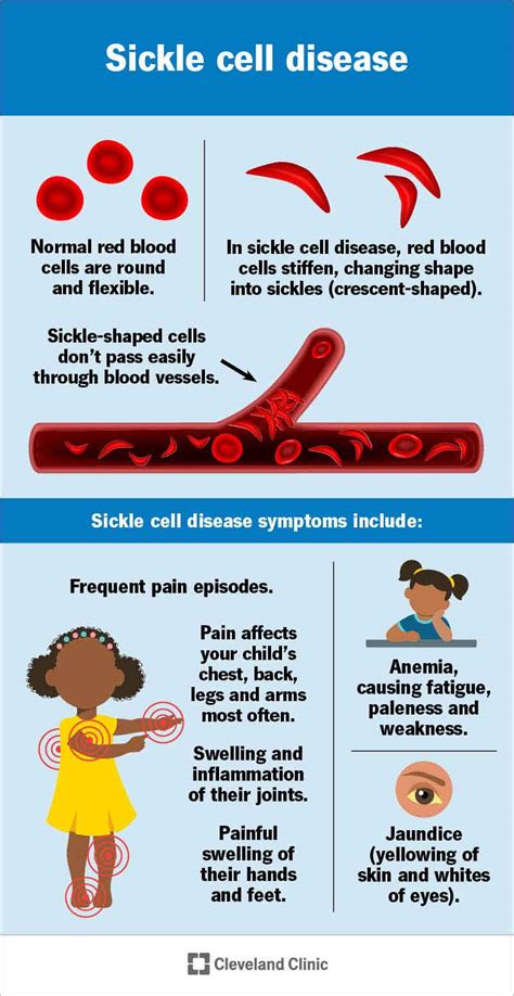 Sickle Cell Disease Scd Types Symptoms Causes