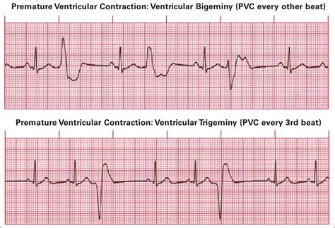 Cardiac Arrhythmia Premature Ventricular Contractions