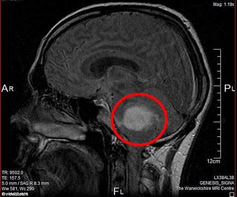 Mri Scans To Predict Patients Ability To Fight Cancer Elets Ehealth