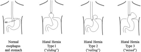 Classification Of Hiatal Hernias Is Shown True Paraesophageal