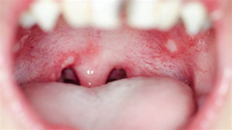 White Spots On Lips And Throat