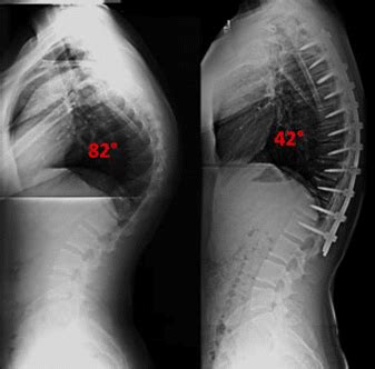 Cifose Torácica Ortopedia e Cirurgia da Coluna