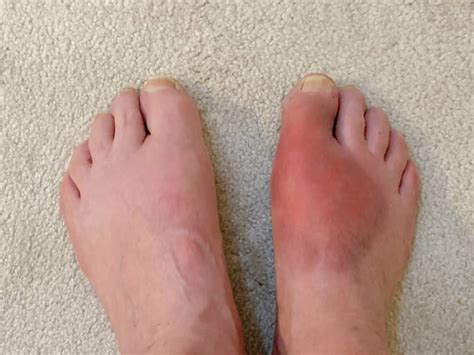What Is Inflammation The Good And The Bad Feet First Clinic