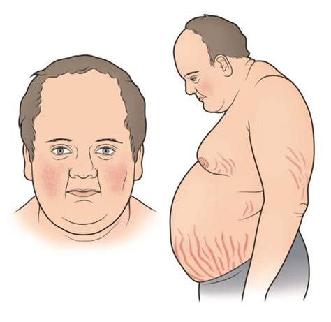 Complications And Treatments Of Cushing Syndrome