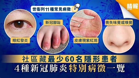 產業動態 產業分析 名家觀點 國際專欄 國際綜合 外媒解析 投資理財 達人帶路 隱形冠軍 職場充電. 【新冠肺炎】社區藏最少60名隱形患者 4種新冠肺炎特別病徵一覽 - 晴報 - 健康 - 呼吸道疾病 - D200714